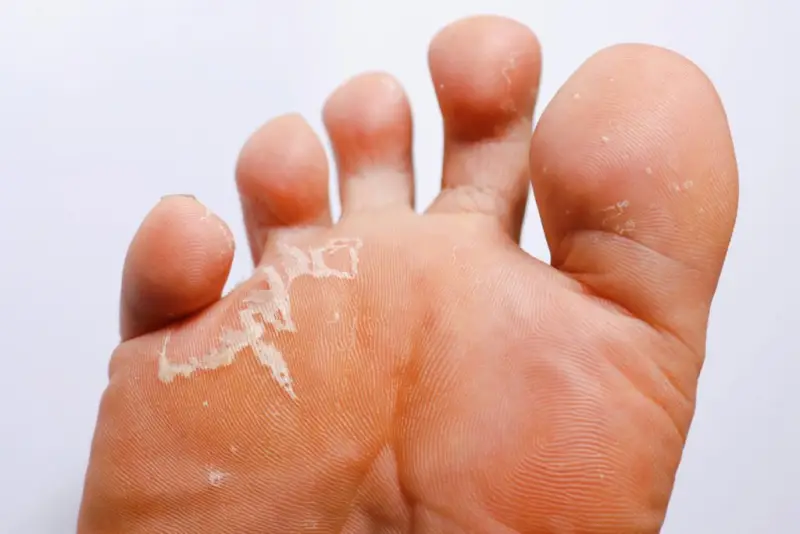 عفونت قارچی معروف به پای ورزشکار