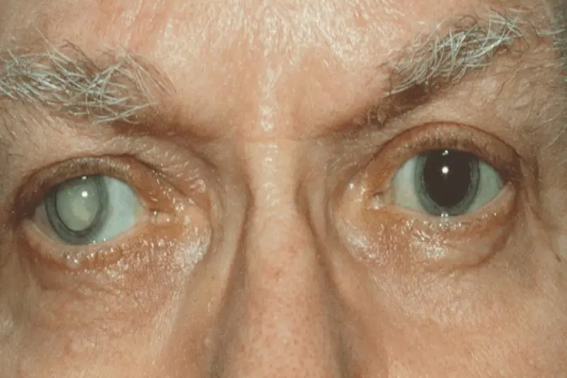 کاتاراکتCataract