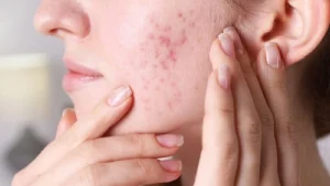۱۰ روش ساده و مؤثر برای مدیریت آکنه هورمونی