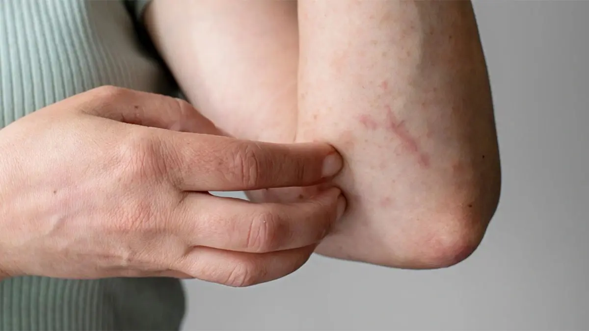 دیابت و پوست