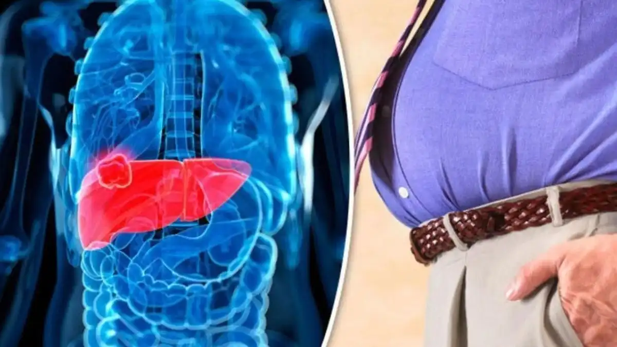 ارتباط کبد چرب و چاقی