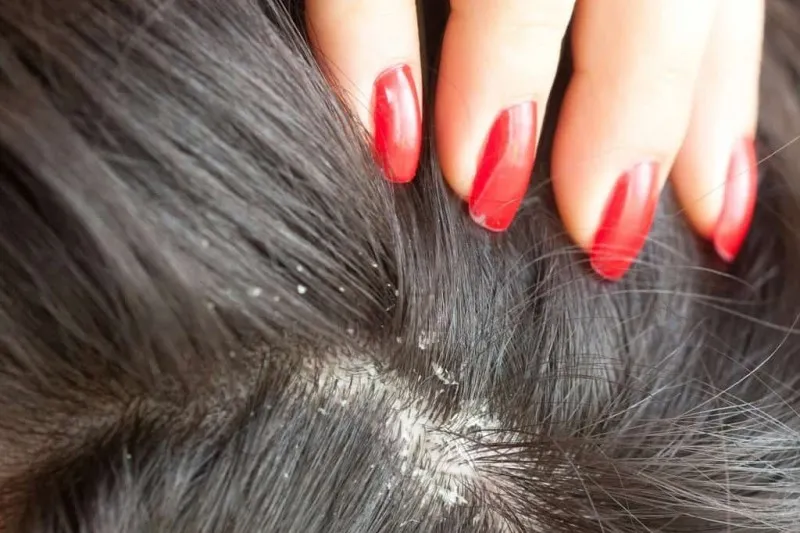 - مهمترین علل شوره سر 1