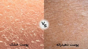 تفاوت پوست خشک و پوست دهیدراته