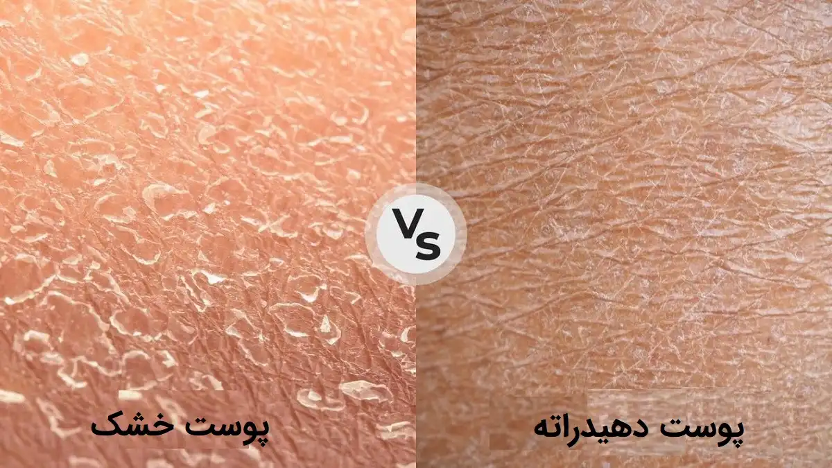 تفاوت پوست خشک و پوست دهیدراته
