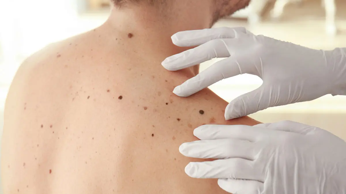 سرطان پوست در مردان