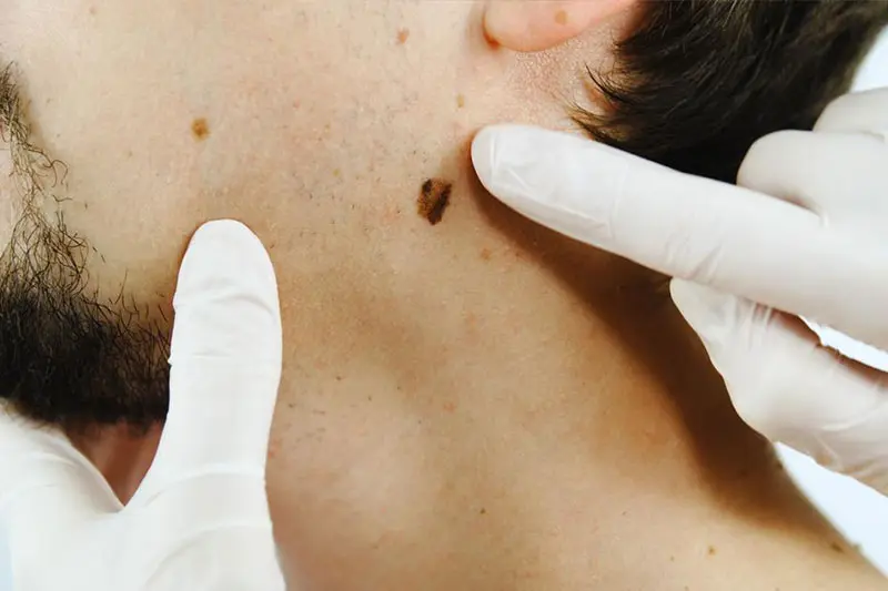 انواع سرطان پوست