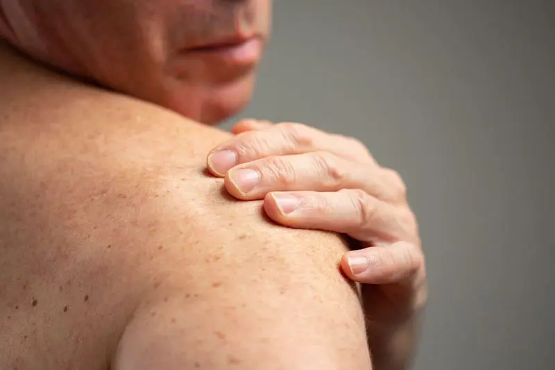 پیشگیری از سرطان پوست