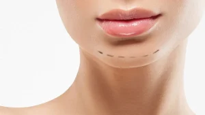 زاویه سازی صورت با ژل یا چربی، کدام بهتر است؟