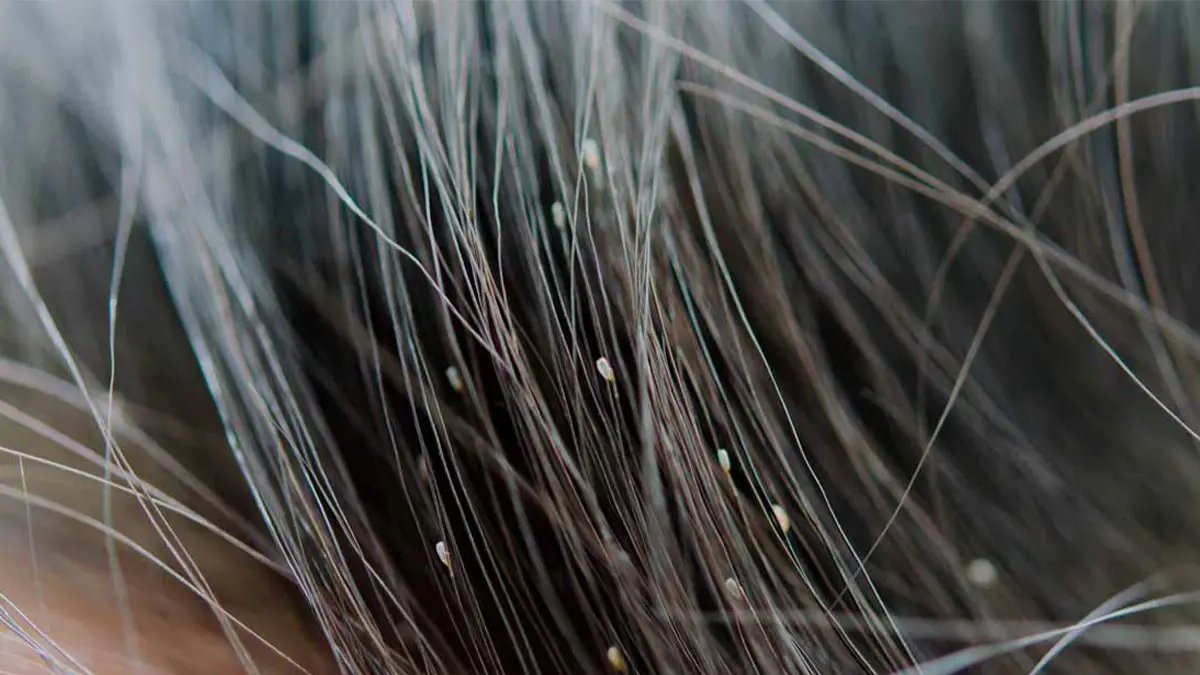 درمان شپش با سرکه