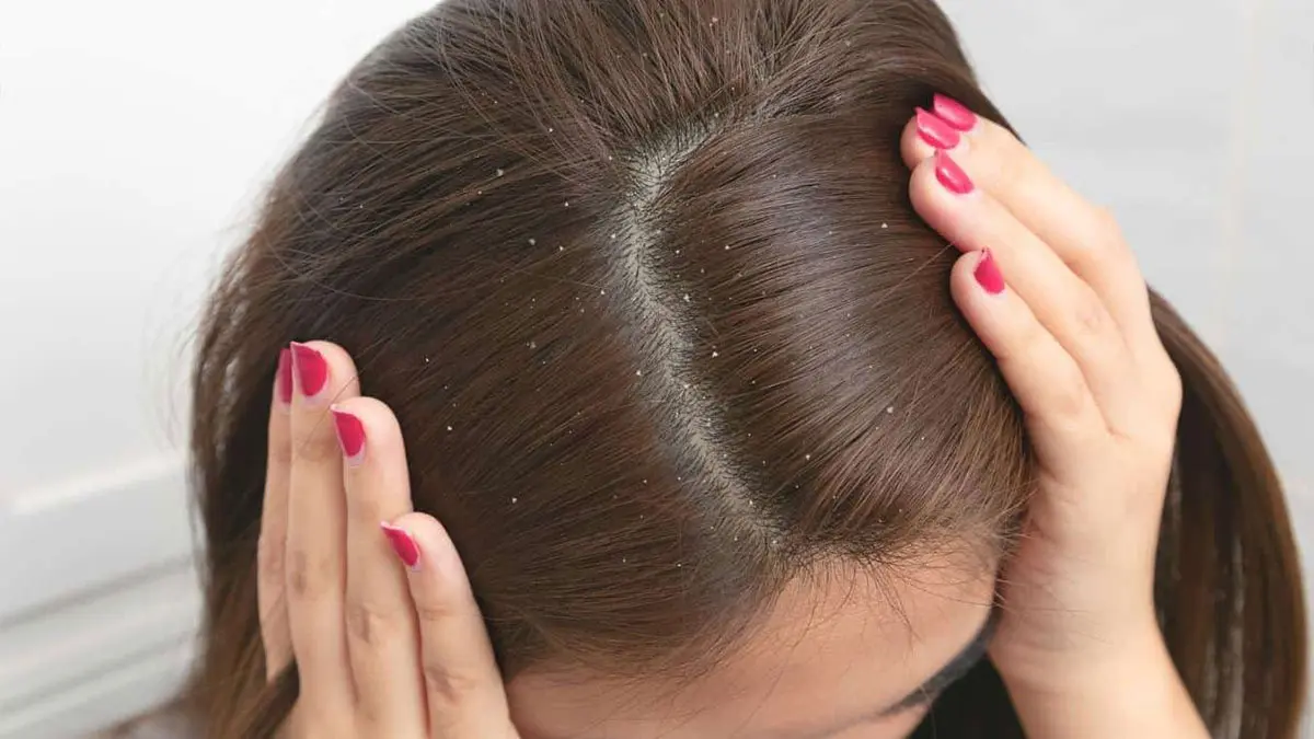 تأثیر استفاده از رنگ مو بر شوره سر