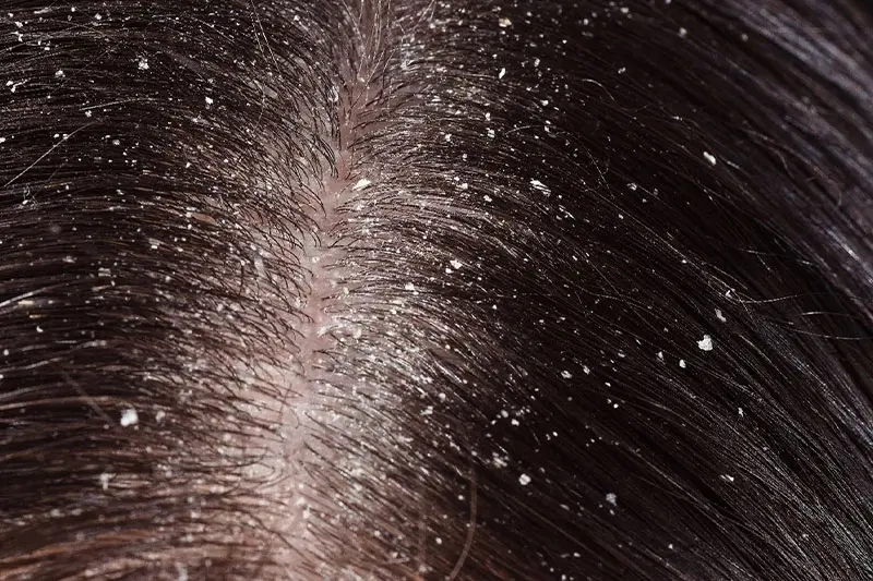 رنگ مو چگونه باعث شوره سر می شود؟