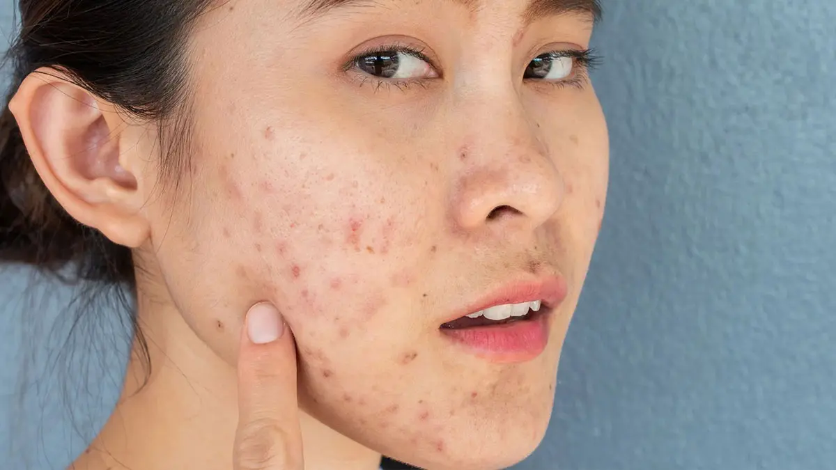 اشتباهات رایج در شستن صورت که باعث جوش میشود