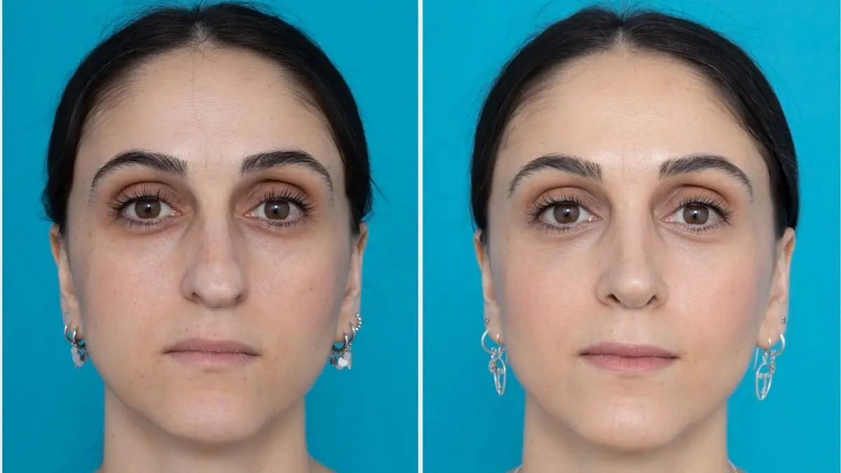 چه کسانی نباید عمل زیبایی بینی انجام دهند