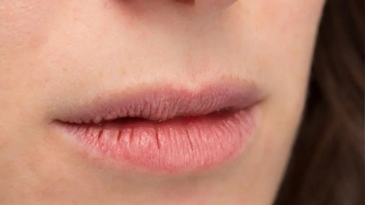 - خشکی لب در پاییز 1