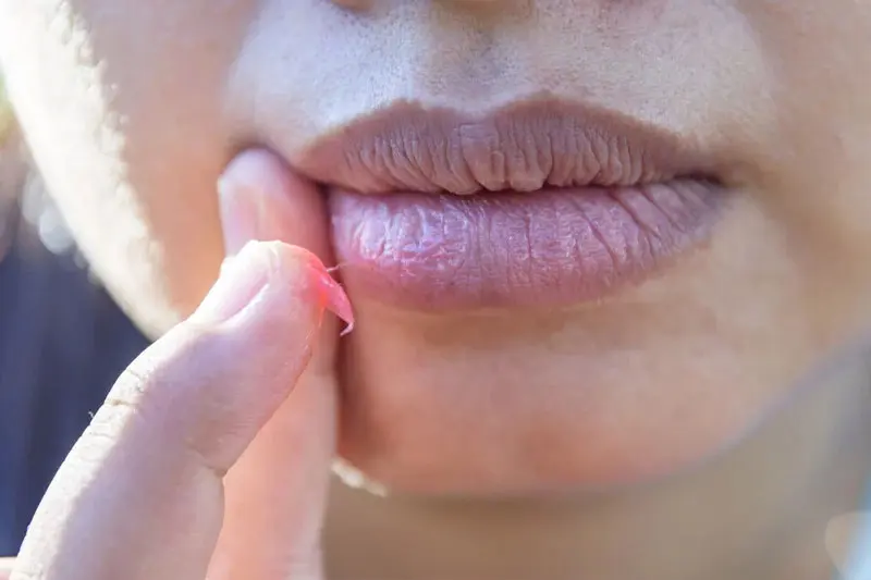 - خشکی لب در پاییز 2