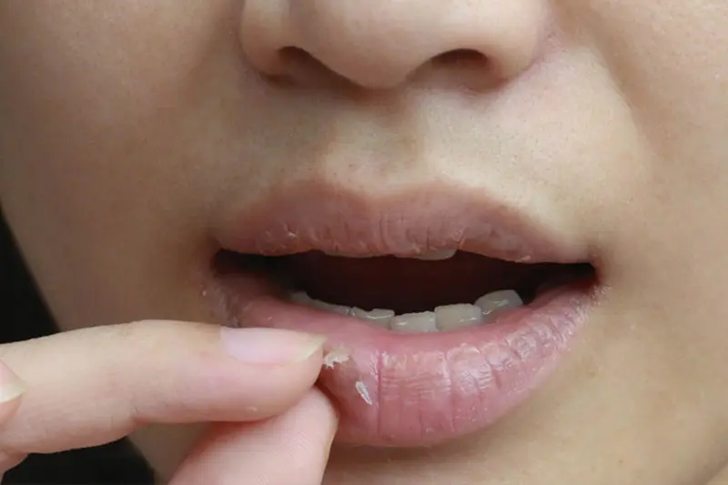 - خشکی لب در پاییز 3