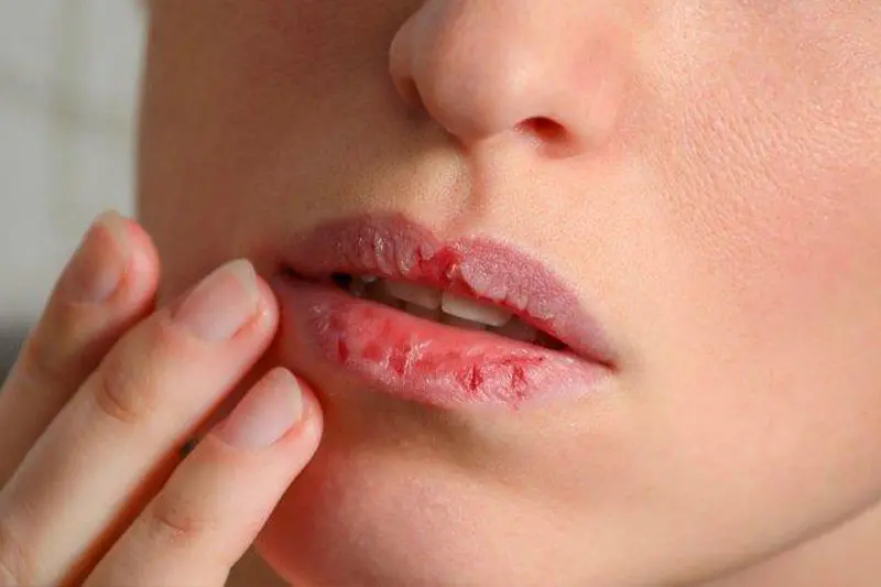 - خشکی لب در پاییز 4