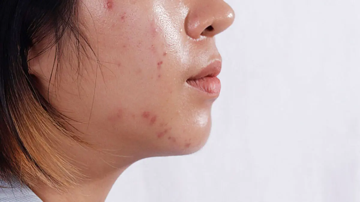 چرا پوست مدام چرب می شود؟