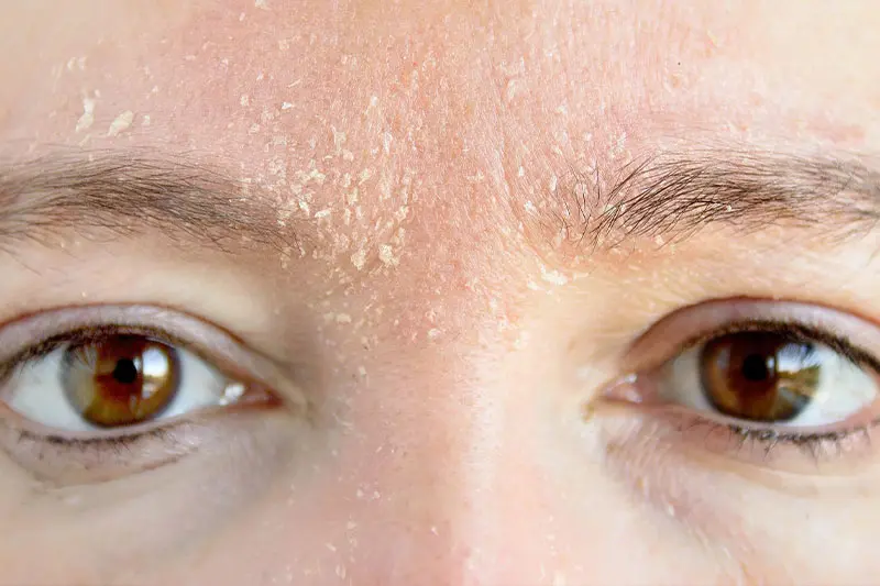 لایهبرداری بیش از حد