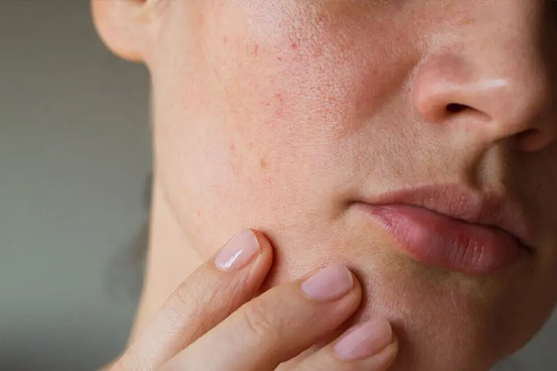 - بهترین ترکیبات کرم برای پوست خشک 3