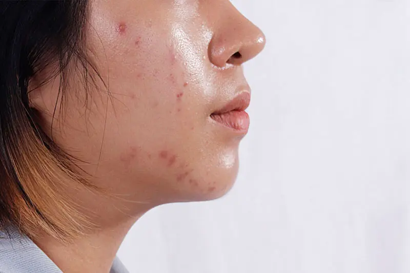 - دابل کلینزینگ برای پوست آکنهای 3