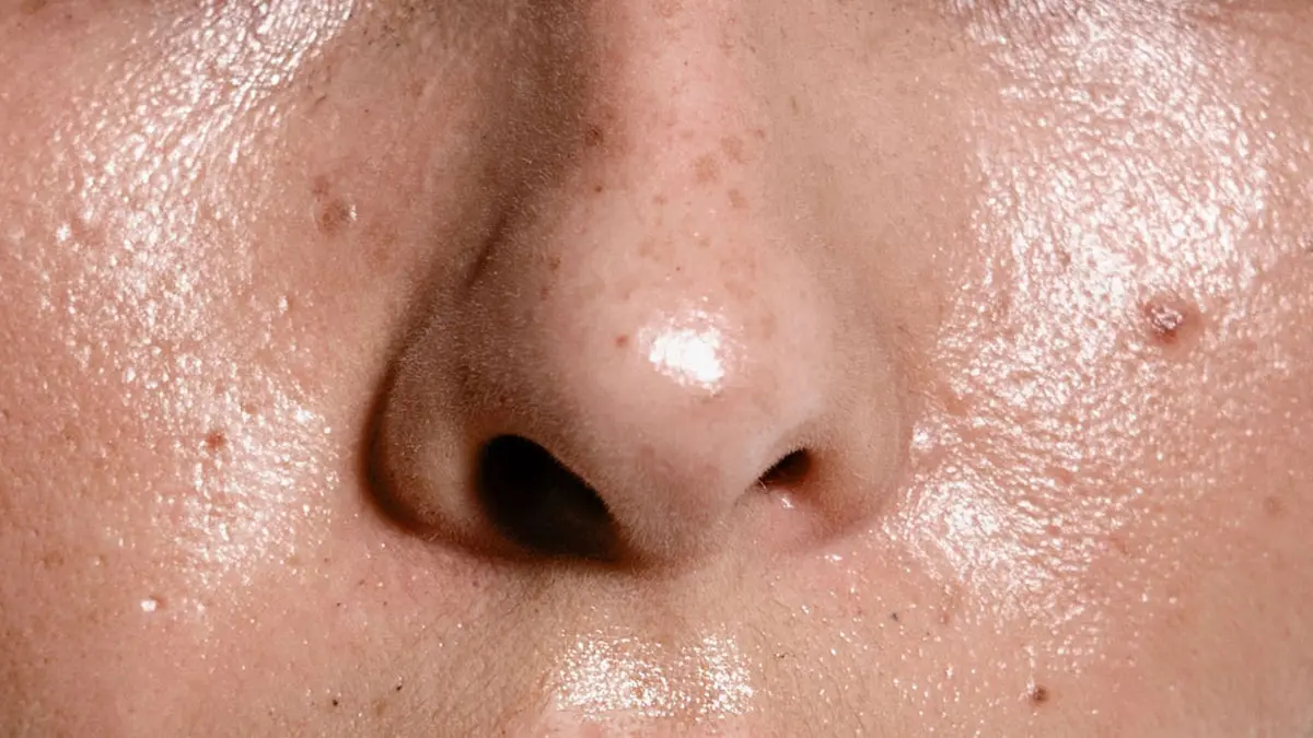 کنترل چربی پوست