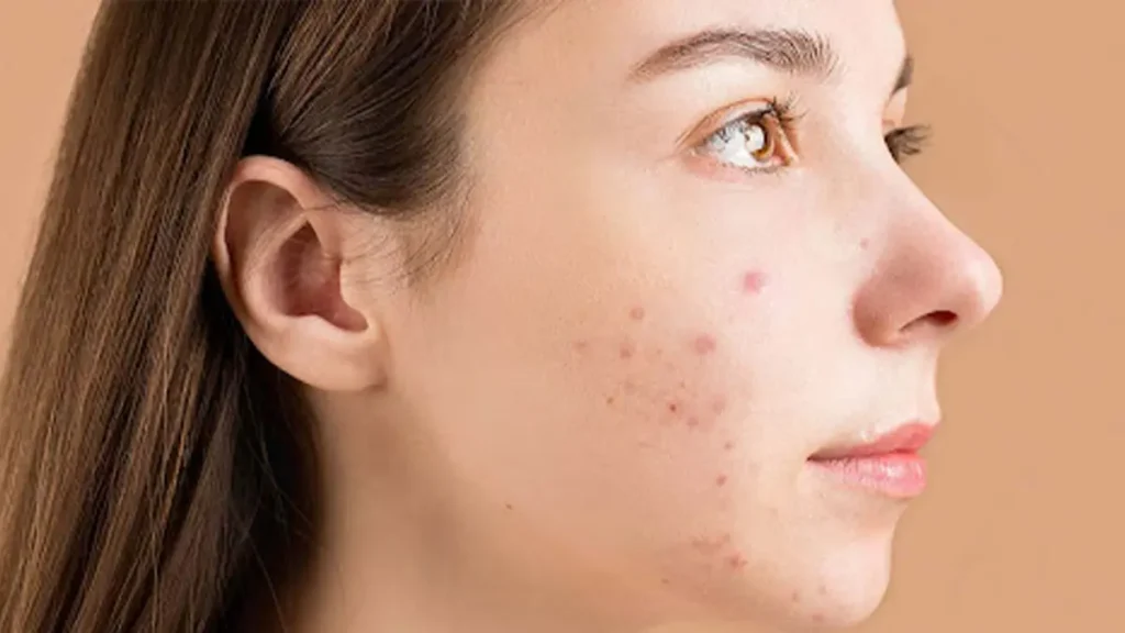 best acne remedies always have your bag