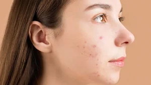 best acne remedies always have your bag