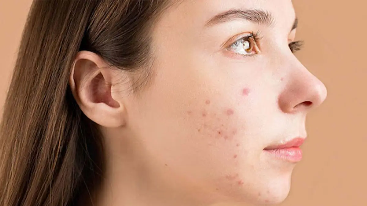 best acne remedies always have your bag