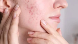 مقایسه بنزوئیل پراکسید و اسید سالیسیلیک