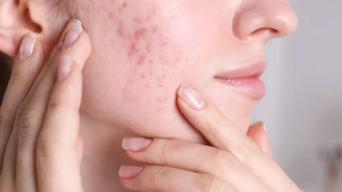 مقایسه بنزوئیل پراکسید و اسید سالیسیلیک