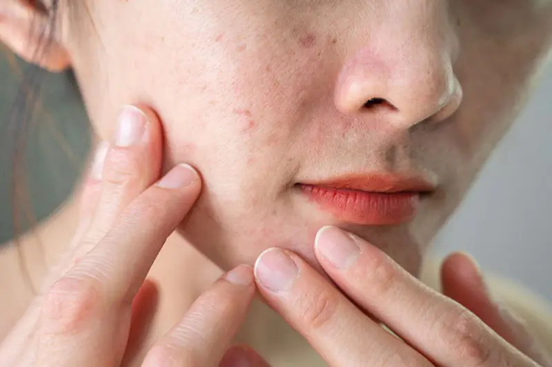 - روتین مراقبت از پوستهای مستعد آکنه در زمستان و تابستان 2