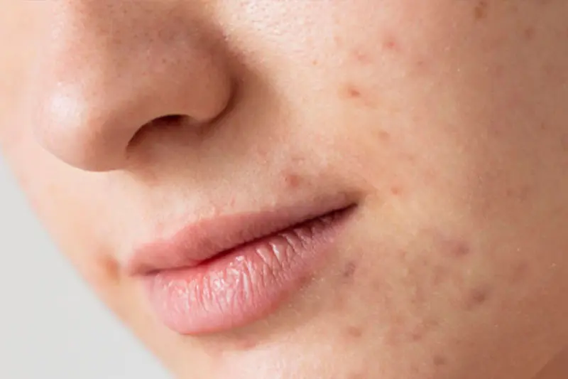 - روتین مراقبت از پوستهای مستعد آکنه در زمستان و تابستان 3