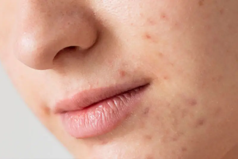 نواحی درگیر آکنه کداماند؟