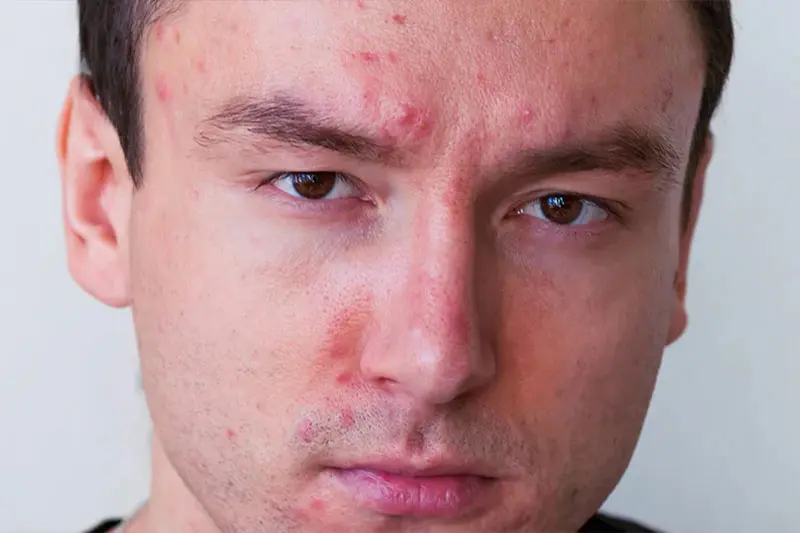 تاثیرات و فواید روی بر آکنه