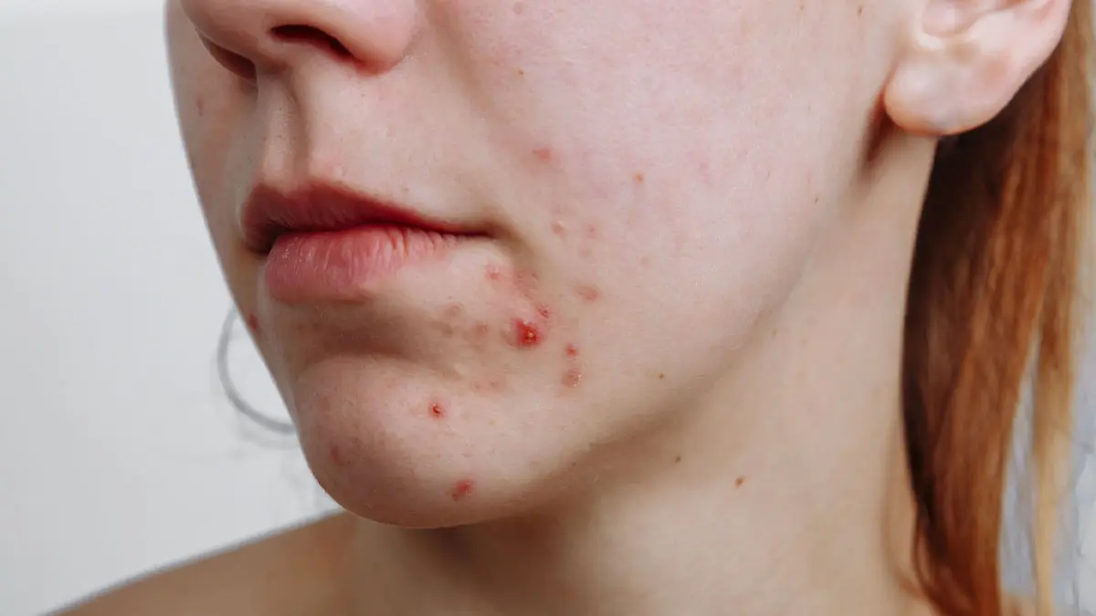 امگا ۳ و آکنه