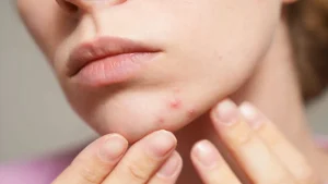 آیا دست زدن به پوست باعث آکنه می‌شود؟