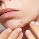 آیا دست زدن به پوست باعث آکنه میشود؟