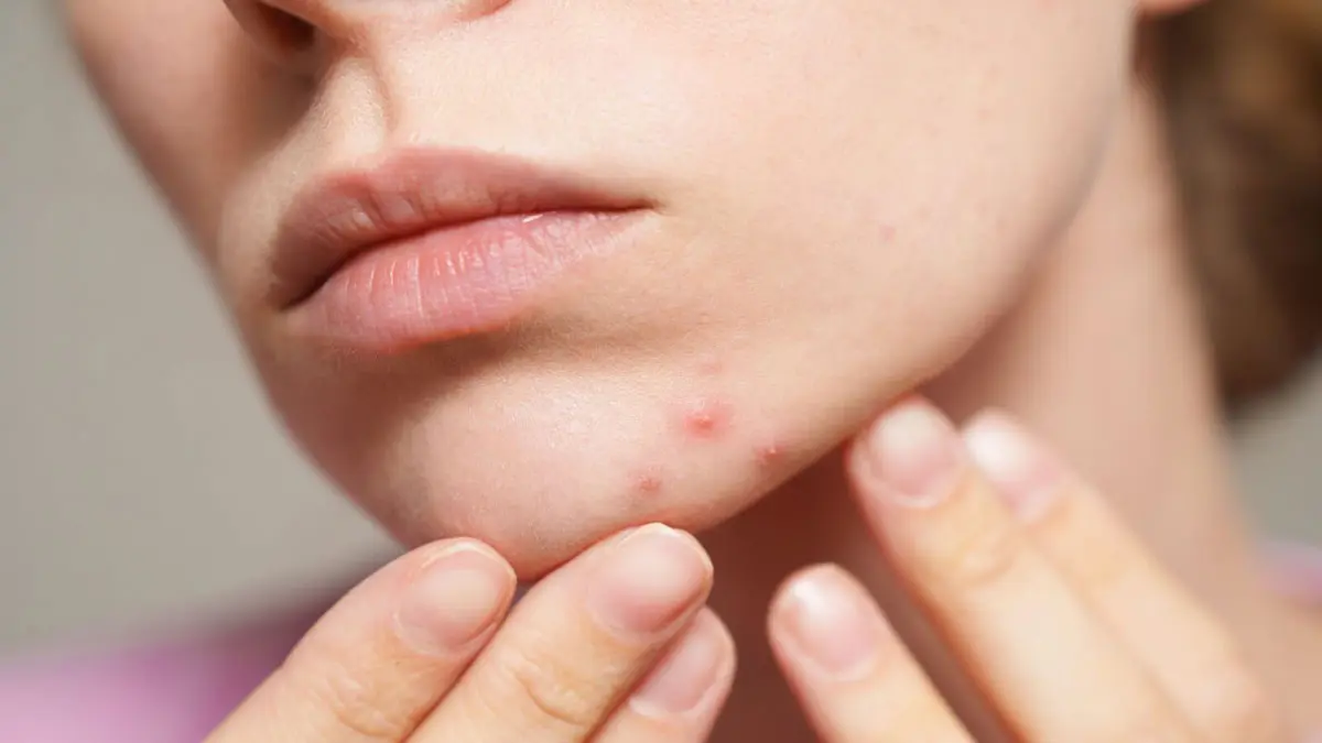 آیا دست زدن به پوست باعث آکنه میشود؟