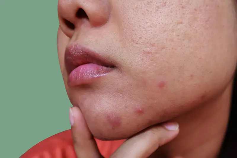 چرا لمس صورت آکنه را بدتر میکند؟