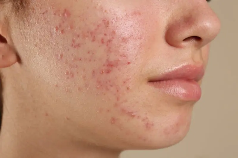 آیا دست زدن به پوست باعث آکنه میشود؟