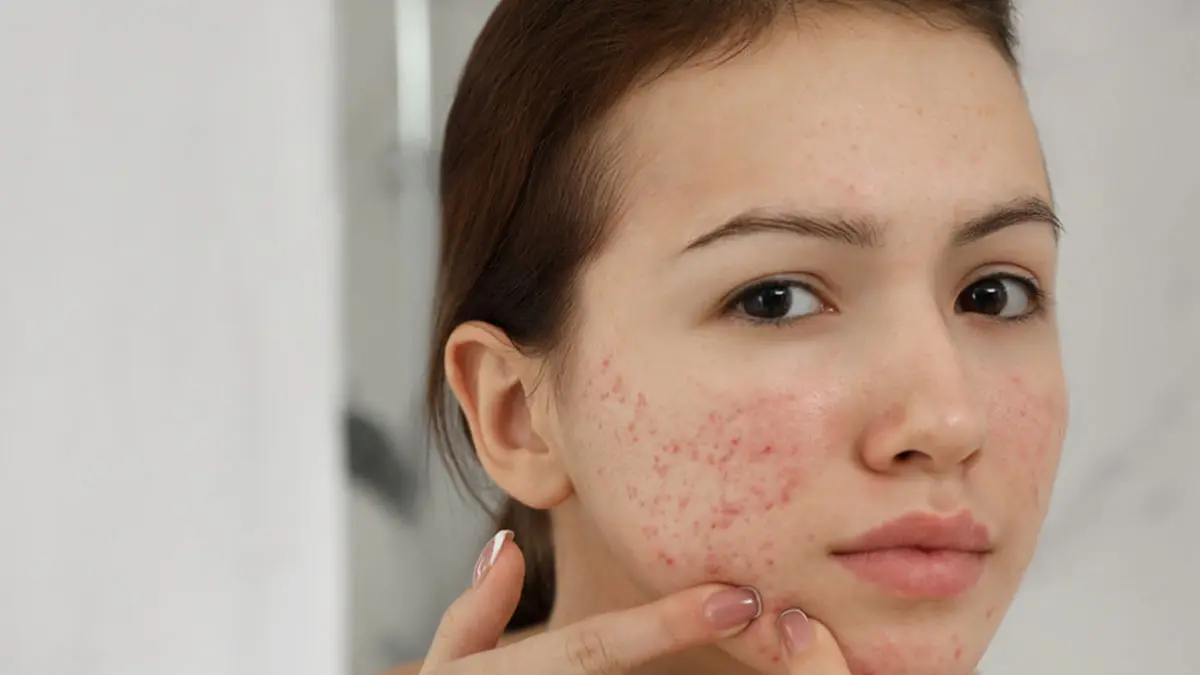 آیا شیر و لبنیات میتوانند باعث ایجاد آکنه شوند؟