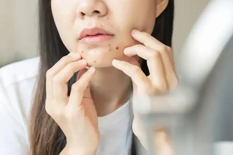 لبنیات و آکنه: آیا ارتباطی بین آنها وجود دارد؟