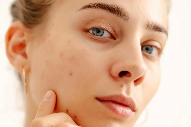 اریتم پس از التهاب (PIE)