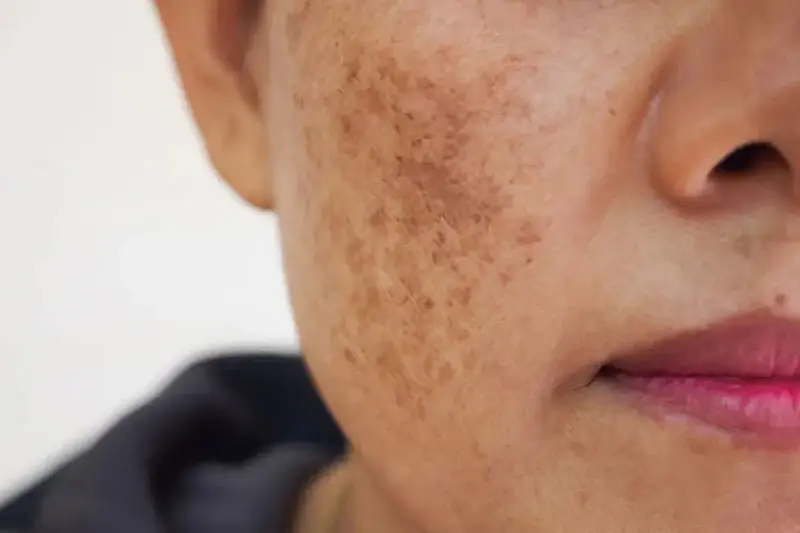 رتینوئیدها (رتینول) برای بازسازی سطح پوست