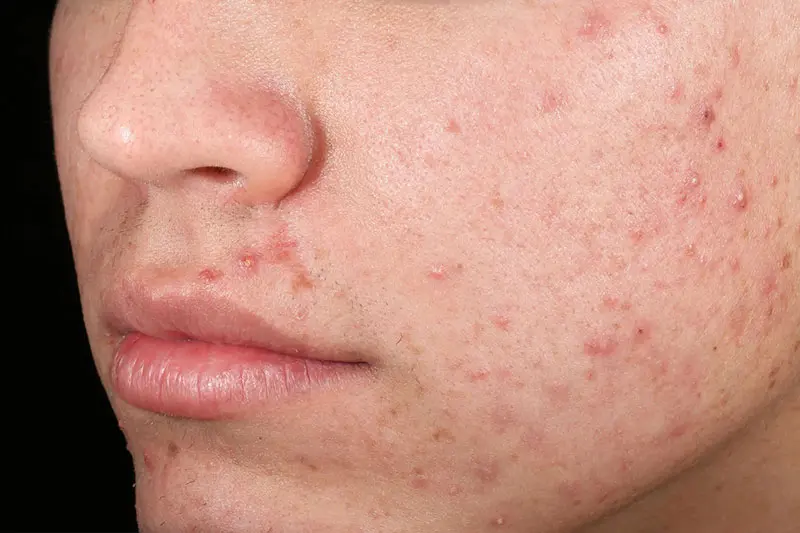 نحوه استفاده از سرم ضد جای جوش در روتین پوستی (نسخه کمریسک)