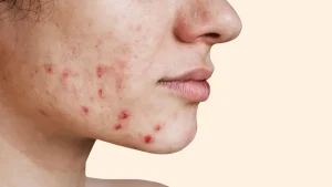 آکنه ناشی از استرس در برابر آکنه هورمونی