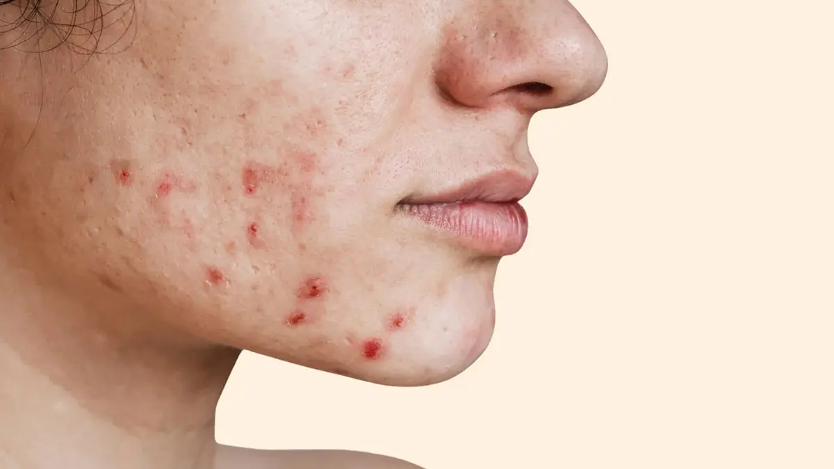 آکنه ناشی از استرس در برابر آکنه هورمونی