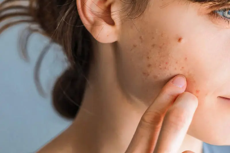 آکنه ناشی از استرس در برابر آکنه هورمونی