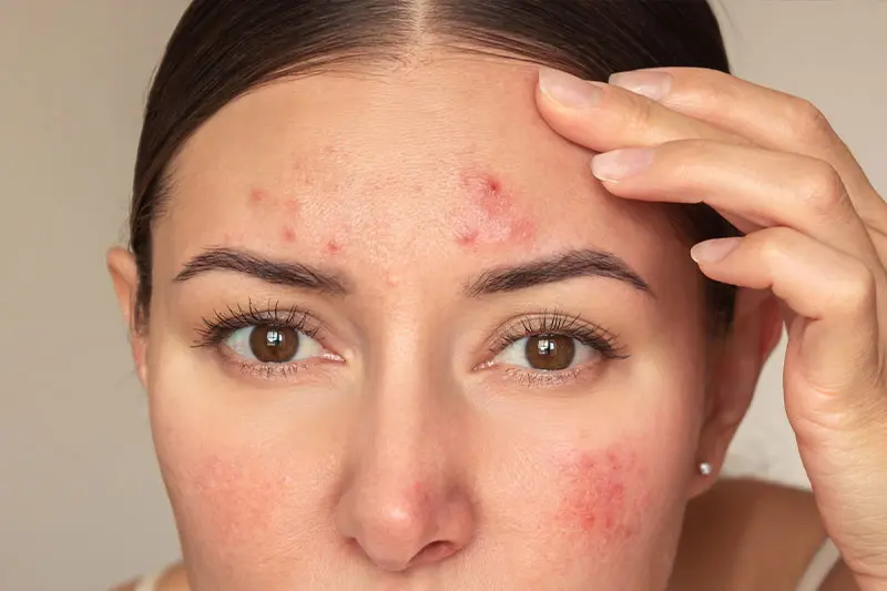 آکنه ناشی از استرس در برابر آکنه هورمونی